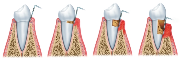 Stages of Gum Disease