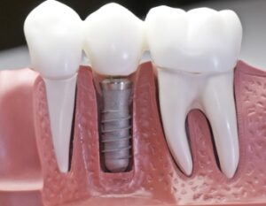 Benefits of dental implants