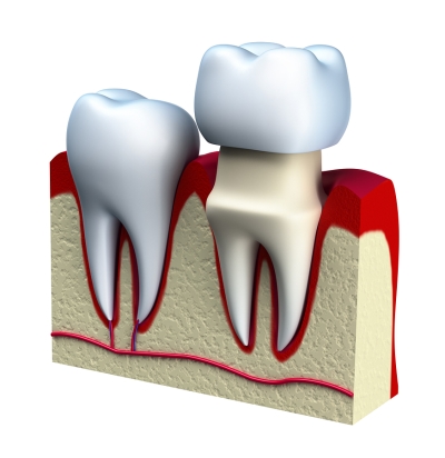 Types of dental crowns