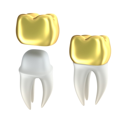 How Dental Crowns work