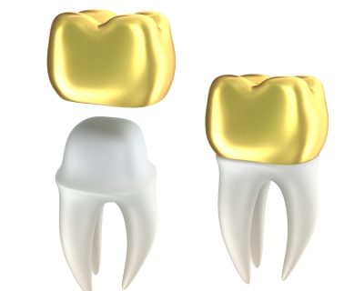 How Dental Crowns work