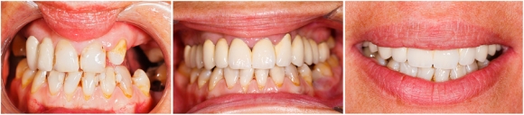 Dental Patient's Guide to Inlays