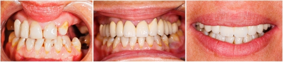 Dental Patient's Guide to Inlays Dental Patient's Guide to Inlays
