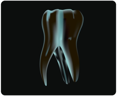 Root canals treatments