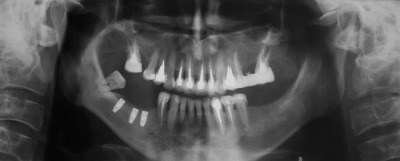 A Look at the Dental Implant Procedure