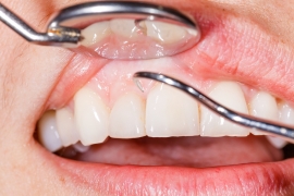 Treating Gum Disease by Belmont Dental Group