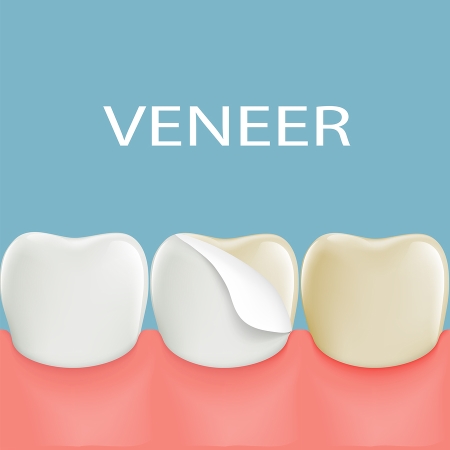 Dental Veneers at Belmont Dental Group