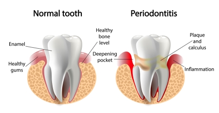Tips for Preventing Periodontal Disease