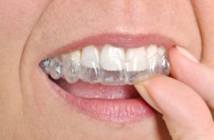 Invisible braces treatment in Belmont