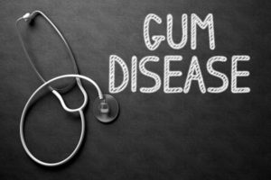 Causes of gum disease