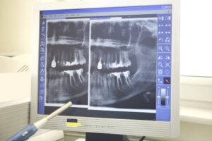 Highlighting Root Canals