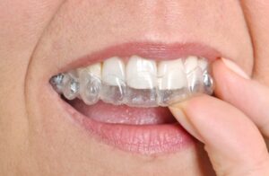 Invisalign Benefits in Belmont, MA