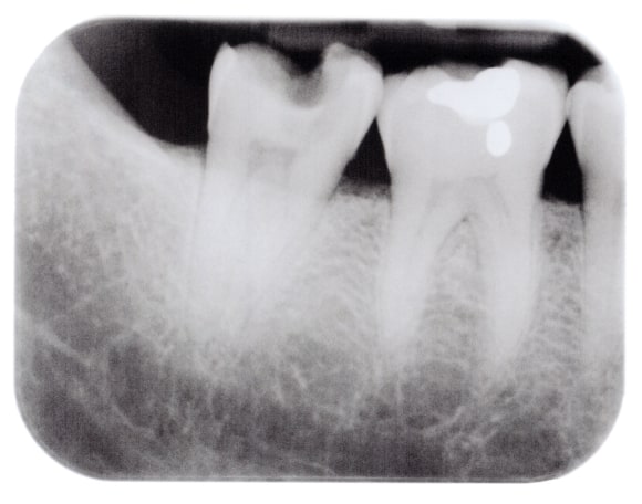 Overview of Xerostomia