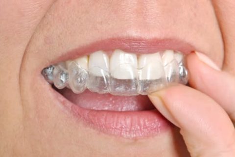 Adjusting to Life with Invisalign