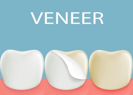 Reduce Tooth Sensitivity of Veneers