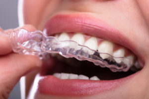 Working of Invisalign Treatment