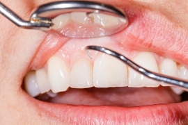 How to Identify Receding Gums