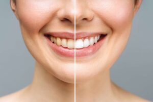 teeth whitening strips before and after