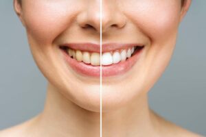 Teeth Whitening, Porcelain Veneers, or Both