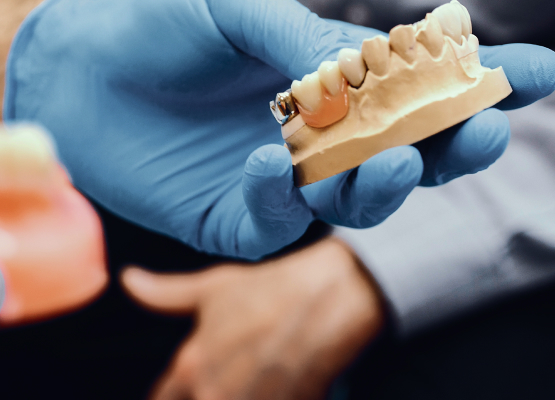 Close-up of a gloved hand holding a dental mold with teeth, demonstrating dental prosthetics or orthodontic work.