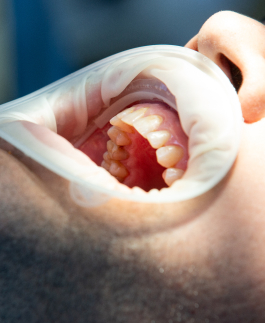 Close-up of a person's open mouth during a dental procedure, showing teeth, gums, and part of a dental retractor used to keep the mouth open.