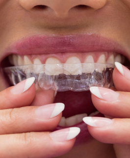 A close-up showing a person fitting a clear dental aligner onto their teeth, with well-manicured nails visible.