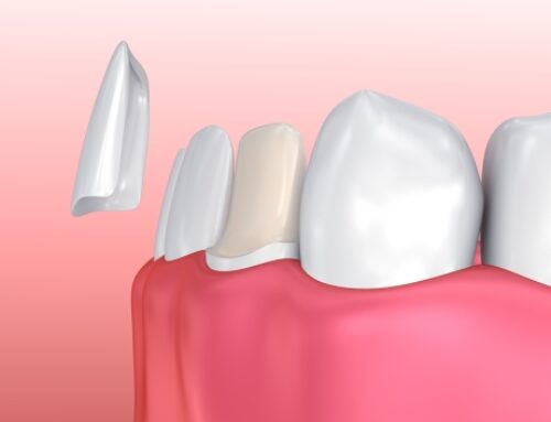 WHEN TO HAVE YOUR VENEERS REPLACED