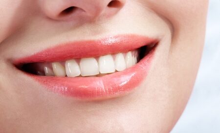 Permanent Teeth Whitening at Belmont Dental Group (Ma)