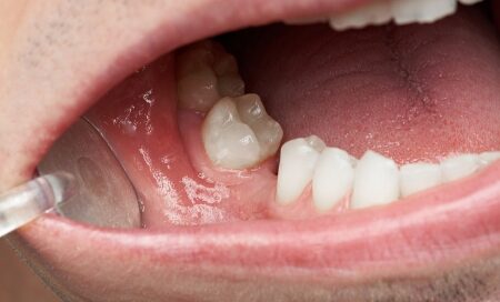 Importance of Replacing Missing Teeth