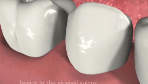 Close-up illustration of teeth and gums with text "Periodontal disease begins in the gingival sulcus," indicating what causes gum disease starting at the gumline.