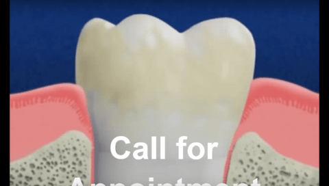 Illustration of a tooth with gum inflammation, showing bone structure and tissues. Text on the image reads, "Call for Appointment.