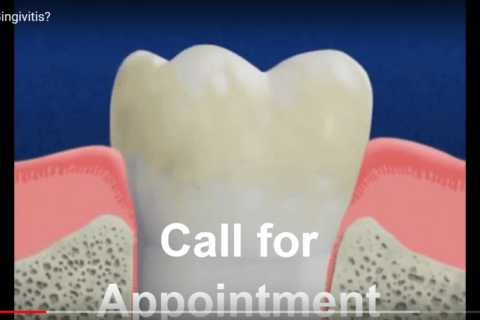 GINGIVITIS 101