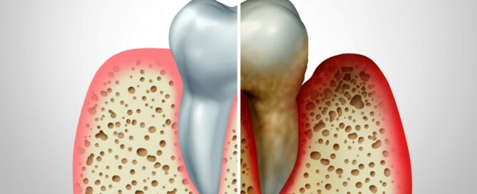 Gum Disease