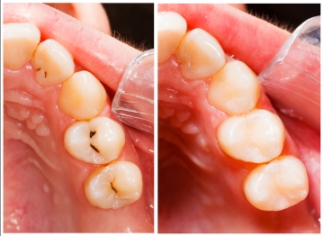 ANSWERING QUESTIONS ABOUT COMPOSITE FILLINGS