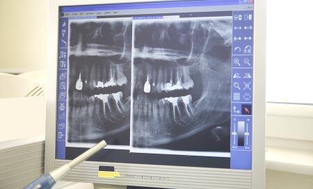 A computer screen displays dental x-ray images, showing the upper and lower jaw with several teeth and dental implants. A pen is pointing at one of the images.