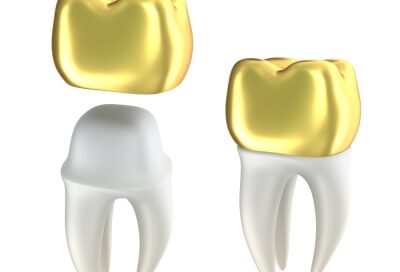 How Dental Crowns work