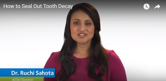 Sealing Out Tooth Decay
