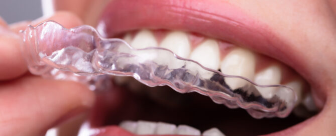 Close-up of a person inserting a transparent dental aligner over their upper teeth, showing a clear view of their teeth and aligner.