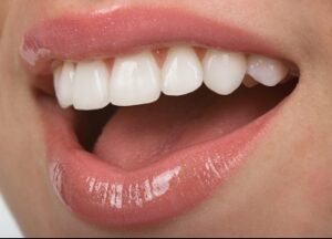 Dental veneers for patients
