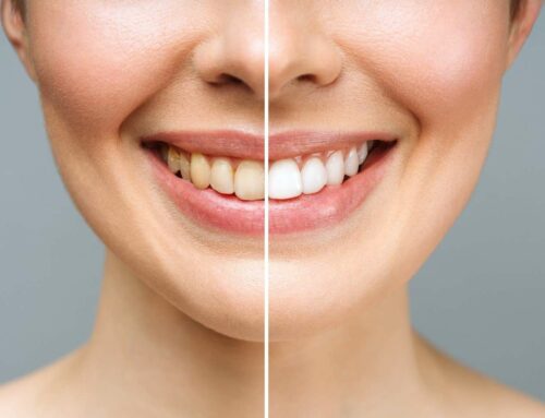 Do Teeth Whitening Strips Work?