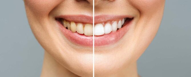 Teeth Whitening, Porcelain Veneers, or Both
