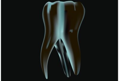 Importance of Root Canal