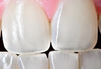 Symptoms Of Bruxism