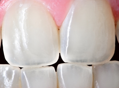 WHAT ARE THE SYMPTOMS OF BRUXISM?