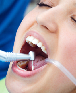 Close-up of a person at the dentist at Belmont Dental Group, mouth open, receiving dental treatment with tools and suction tube visible.