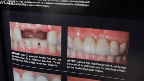 A close-up of a before and after comparison of a dental treatment for a 37-year-old female, showing significant improvement in teeth alignment and appearance with a 4-unit bridge.