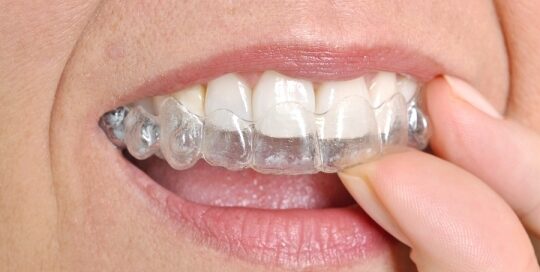 Invisalign Benefits in Belmont, MA