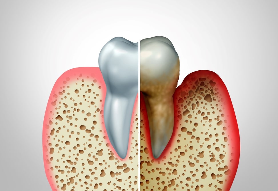 Information on Periodontal Disease
