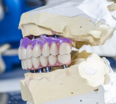 COULD YOU BENEFIT FROM PORCELAIN INLAYS?