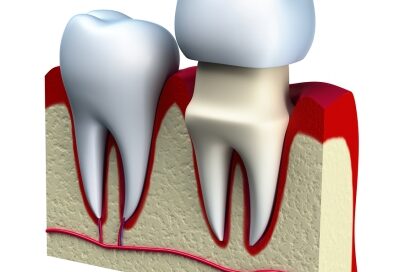 Dental Crowns